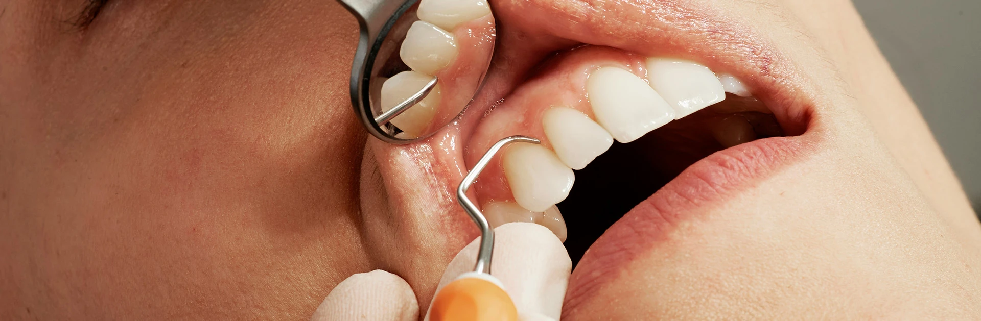 Nahaufnahme eines Zahnarztes, der mit einem Instrument die Zähne eines Patienten auf Parodontitis untersucht. Weiße Zähne und zahnärztliche Werkzeuge sind sichtbar.