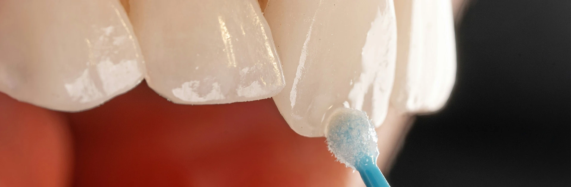 Nahaufnahme von Veneers, die mit einem Applikator bearbeitet werden. Die Oberfläche der Veneers ist glänzend und glatt.