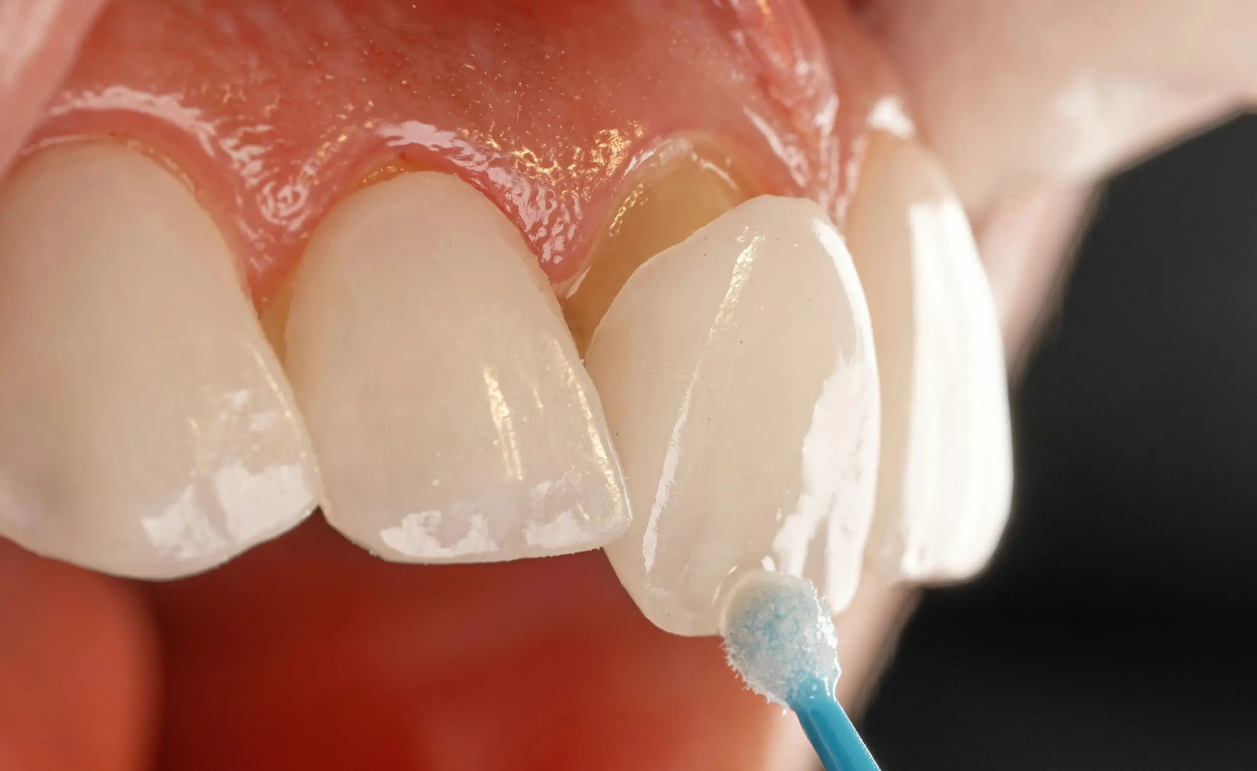 Nahaufnahme von Zähnen mit Veneers, während ein Applikator auf die Oberfläche aufgetragen wird.